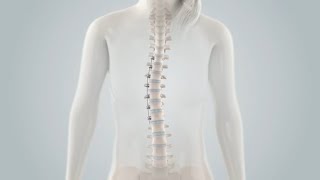 Spinal Tethering Surgery [upl. by Bishop501]