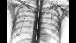 Clavicle Fractures [upl. by Ettennej]