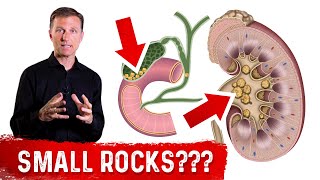 Why Do Stones Develop In Your Kidney and Gallbladder [upl. by Florida]