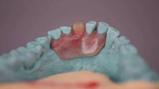 Valplast Flexible Denture [upl. by Bloom]