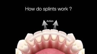 How Do Dental Splints Work [upl. by Reivaz401]