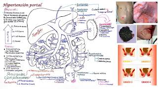 HIPERTENSIÓN PORTAL [upl. by Airotciv]
