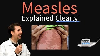 RubeolaMeasles vs RubellaGerman Measles  Arbovirus  NBDEUSMLE [upl. by Arata]