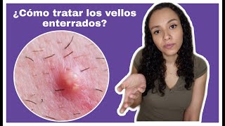 ¿VELLOS ENTERRADOS   FOLICULITIS [upl. by Sunderland244]