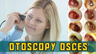 OTOSCOPY OSCEs  PLAB Image Reference [upl. by Roderigo]