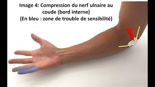 Nerf cubitale ulnaire soulagez sa compression naturellement [upl. by Ardiekal686]