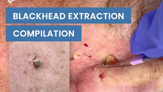 Extraction Satisfaction Blackhead Removal  CONTOUR DERMATOLOGY [upl. by Nyvrem546]