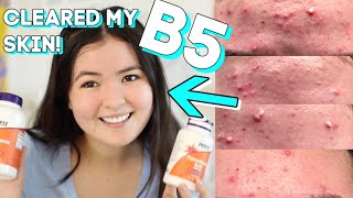 How I Cleared my Skin with Pantothenic acid B5 Acne Gone [upl. by Netsrak]