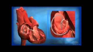 Ablation for AV Node Reentrant Tachycardia AVNRT [upl. by Dressel203]