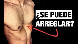 ¡Cómo Arreglar EL PECHO HUNDIDO PECTUS EXCAVATUM [upl. by Delaine]