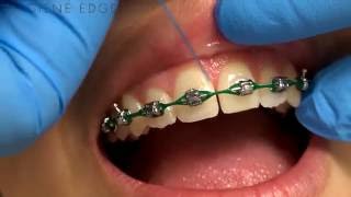 Flossing Braces With a Threader [upl. by Herta]