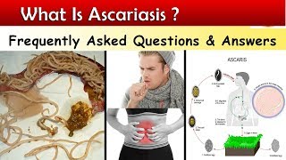 What is Ascariasis   Ascaris Lumbricoids Infections  FAQ [upl. by Elbertina]