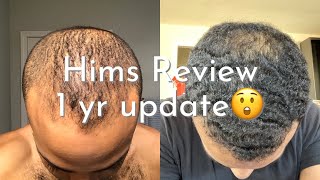 hims finasteride HIMS Review 1 FULL YEAR Update [upl. by Domenech]