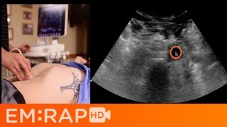 Ultrasound of Abdominal Aortic Aneurysm AAA [upl. by Leuqar]