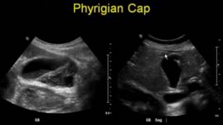 Errors in Gallbladder Ultrasound [upl. by Memberg]