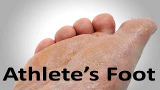 Athletes Foot Fungus Cure in 3 Minutes Simple Home Trick [upl. by Assel]