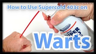 How to Use Supercold 403c Freeze Spray on Warts Skin Tags Moles or Freckles [upl. by Jerrilyn]