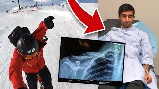 I BROKE MY COLLAR BONE  LIVE FOOTAGE [upl. by Theressa]