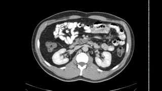 Overview da anatomia do abdome pela TC [upl. by Arehahs]