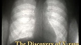 The Discovery of XRays [upl. by Anayek]