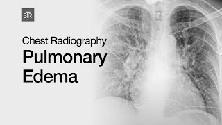 Chest Radiography Pulmonary Edema [upl. by Mada]