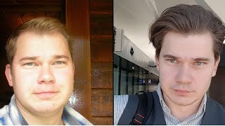 Truth About Finasteride My 12 Year Update Results [upl. by Laeira832]