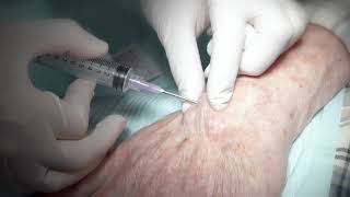 Aspiration of ganglion cyst [upl. by Lyret]