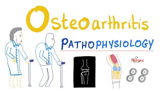 Osteoarthritis OA  Pathophysiology  Rheumatology Series [upl. by Gilbye]