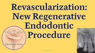 Revascularization  Regenerative Endodontic Procedure [upl. by Maurita254]