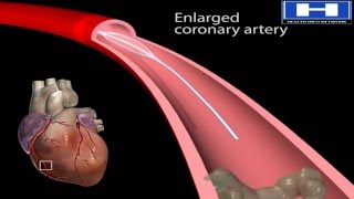 Heart Transplant Surgery 3D Animation [upl. by Notnroht435]