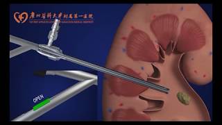 Troubleshooting Your Nephrostomy Tube 10 [upl. by Westerfield]