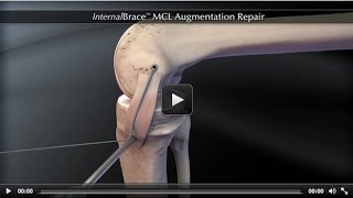 InternalBrace™ MCL Augmentation Repair [upl. by Nolitta]