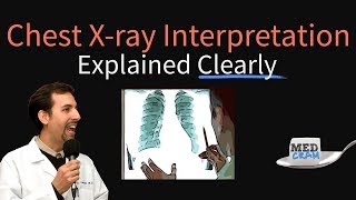 Chest XRay Interpretation Explained Clearly  How to read a CXR [upl. by Froemming]