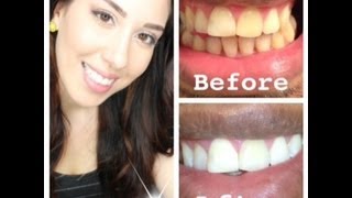 My At Home Teeth Whitening Routine WITH BEFORE AND AFTER PICTURES [upl. by Roslyn]