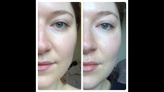 I used Volufiline for 30 days and here are the results  Before amp After Photos [upl. by Jammin245]