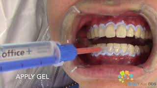 InOffice Teeth Whitening 1 round out of 3 [upl. by Nari]