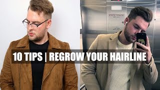 10 Quick Tips How To Stop A Receding Hairline amp Receding Hairline Regrowth [upl. by Rednasyl730]