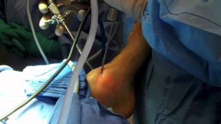 Ankle Arthroscopy [upl. by Ulrick]