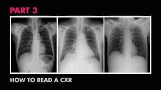 How XRays Work  How to Read a Chest XRay Part 3  MEDZCOOL [upl. by Ahsoem802]