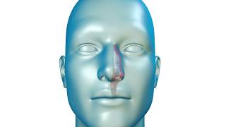 A Solution for Nasal Airway Obstruction [upl. by Nnaeirb]