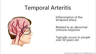 Temporal arteritis [upl. by Nnayllas443]