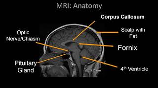 Normal Brain MRI Anatomy  Neuroradiology Made simple [upl. by Claudetta676]