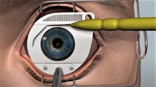 LASIK eye surgery  3D animation [upl. by Yrollam20]