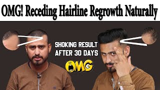 Receding Hairline Regrowth Naturally At Home  How To Stop amp Regrowth Receding Hairline Naturally [upl. by Ynohtnael]