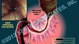 Colonoscopy Sigmoid Stenosis [upl. by Suk128]