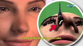 Rinoplastia  Cirurgia Plástica no Nariz [upl. by Cecilio]