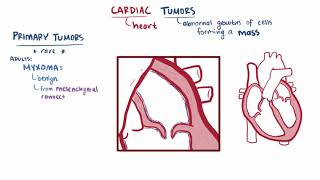 What are Sarcomas  Pathology mini tutorial [upl. by Geer]