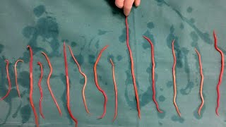 Doctors Remove 14 Roundworms From Woman [upl. by Yanetruoc]