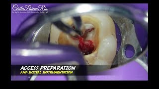 one visit endodontic treatment wisdom tooth perawatan saluran akar 1 kali kunjungan [upl. by Rauscher]