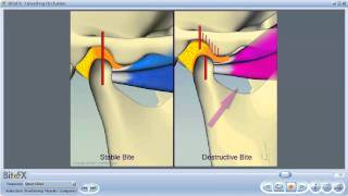 TMJ Disorders [upl. by Felizio]